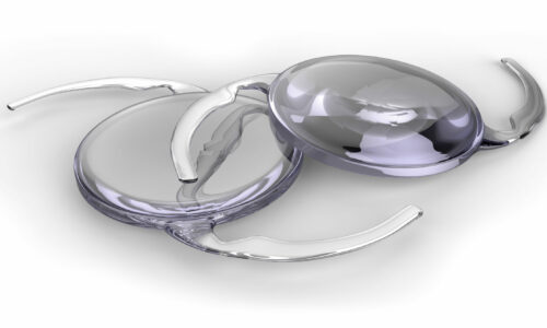 Les Implants Intraoculaires, choix et techniques de pose