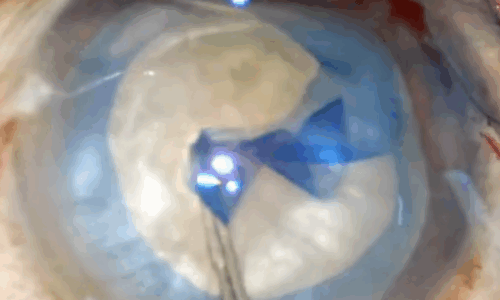 Capsulorhexis Drylab  – Kits d’entraînement  Phaco à domicile à bas coût